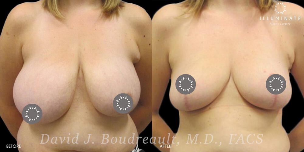 Mastopexy Before & After Image