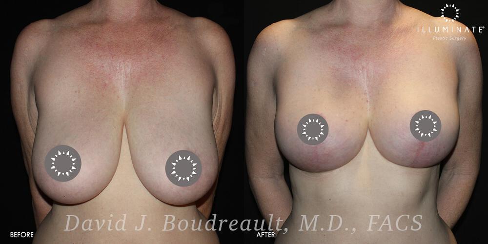 Mastopexy Before & After Image