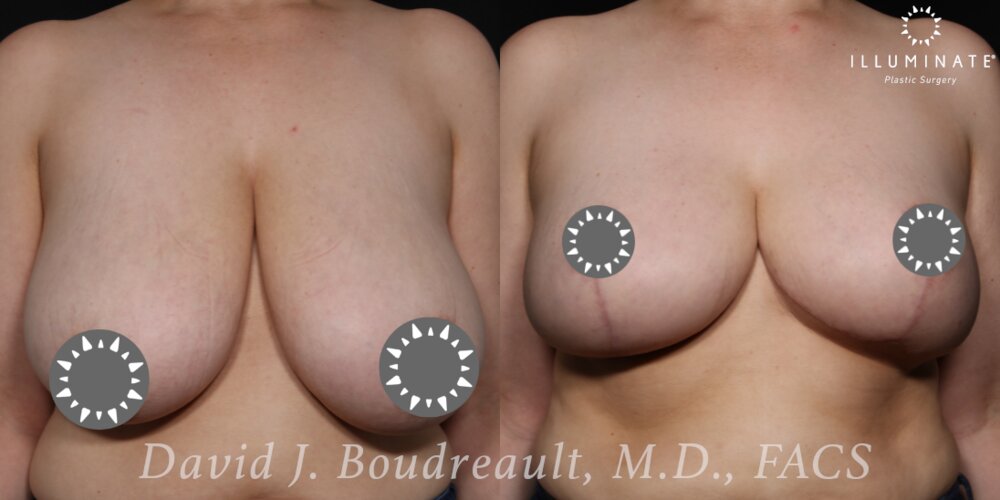 Mastopexy Before & After Image