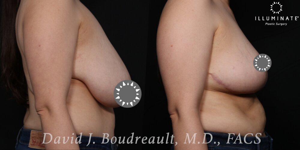 Mastopexy Before & After Image