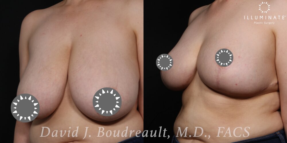 Mastopexy Before & After Image