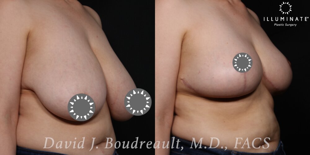 Mastopexy Before & After Image