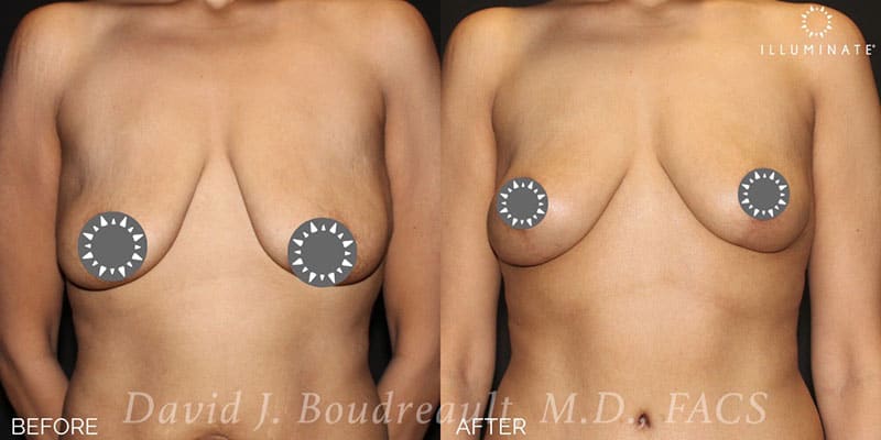 Mastopexy Before & After Image
