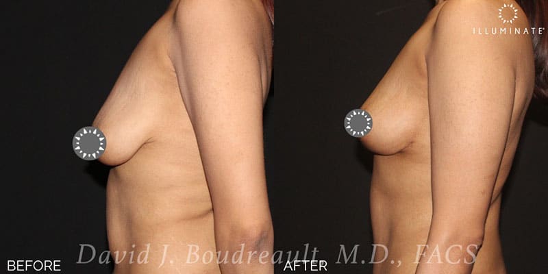 Mastopexy Before & After Image