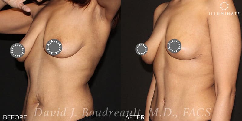 Mastopexy Before & After Image