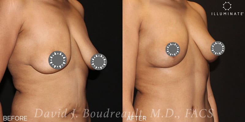 Mastopexy Before & After Image