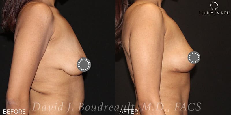 Mastopexy Before & After Image