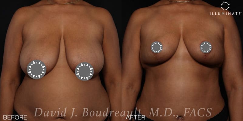 Mastopexy Before & After Image