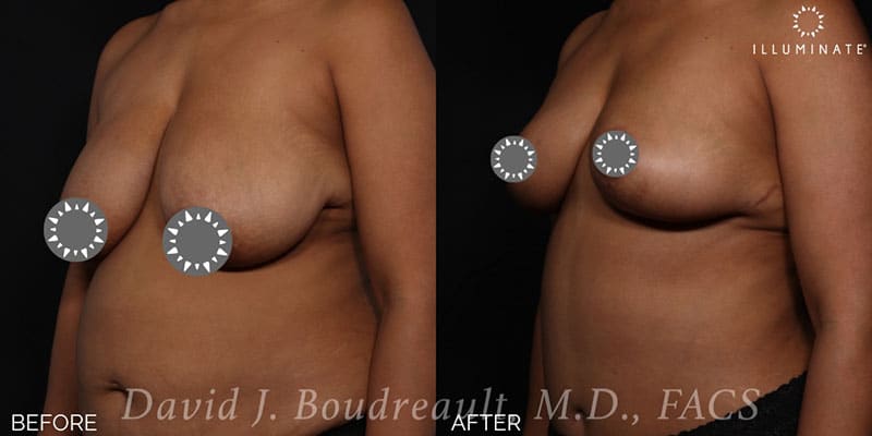 Mastopexy Before & After Image