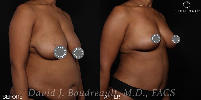 Mastopexy Before & After Image