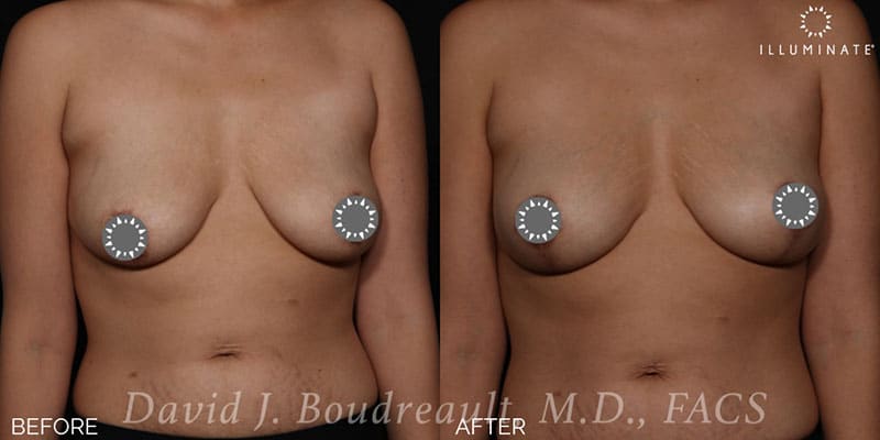 Mastopexy Before & After Image