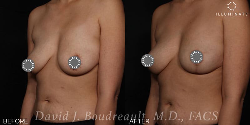 Mastopexy Before & After Image