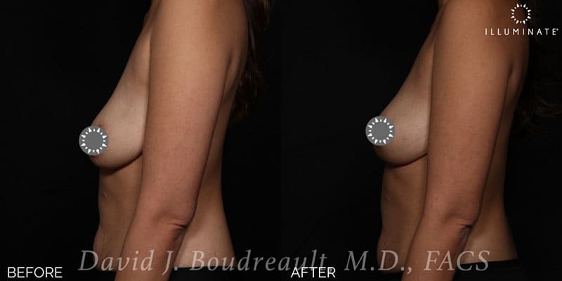 Mastopexy Before & After Image