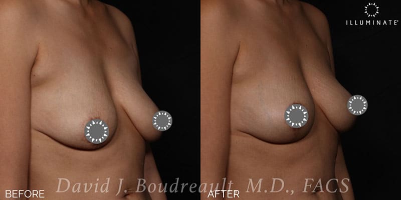 Mastopexy Before & After Image