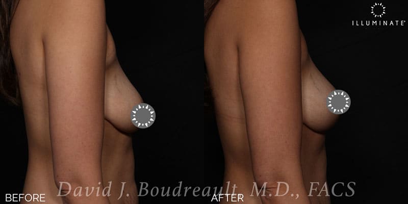 Mastopexy Before & After Image