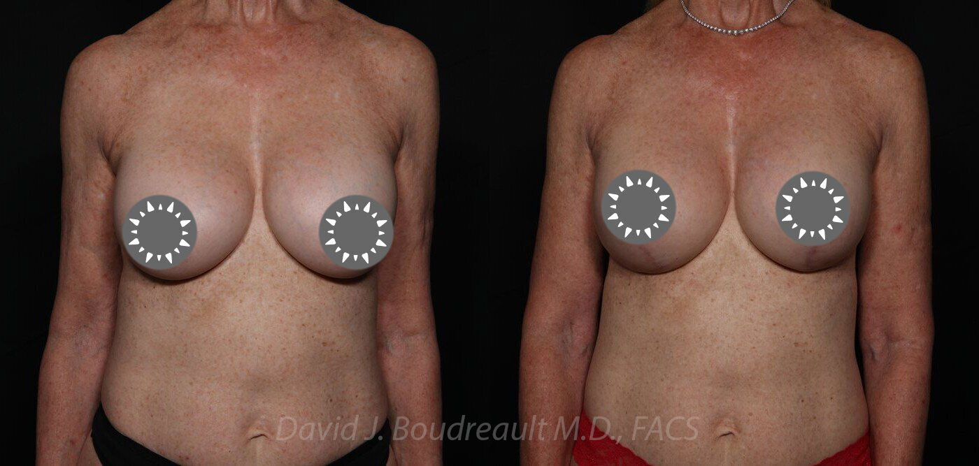 Mastopexy Before & After Image