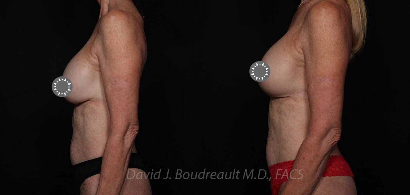 Mastopexy Before & After Image