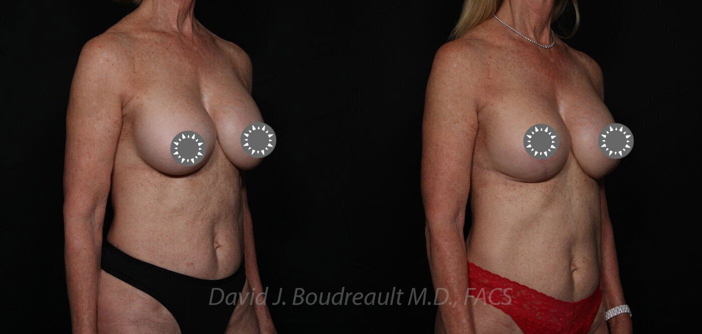 Mastopexy Before & After Image