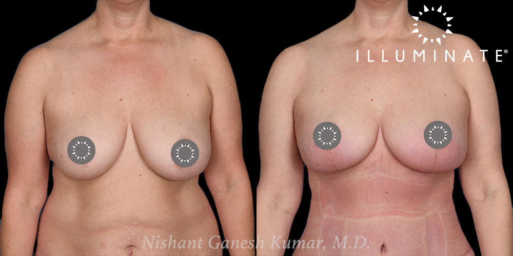 Mastopexy Before & After Image