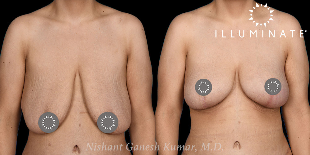 Mastopexy Before & After Image