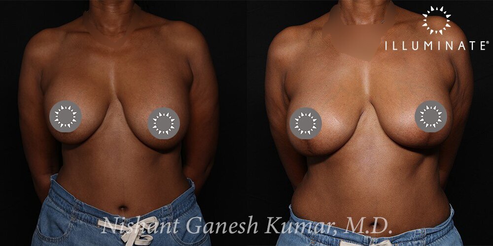 Mastopexy Before & After Image