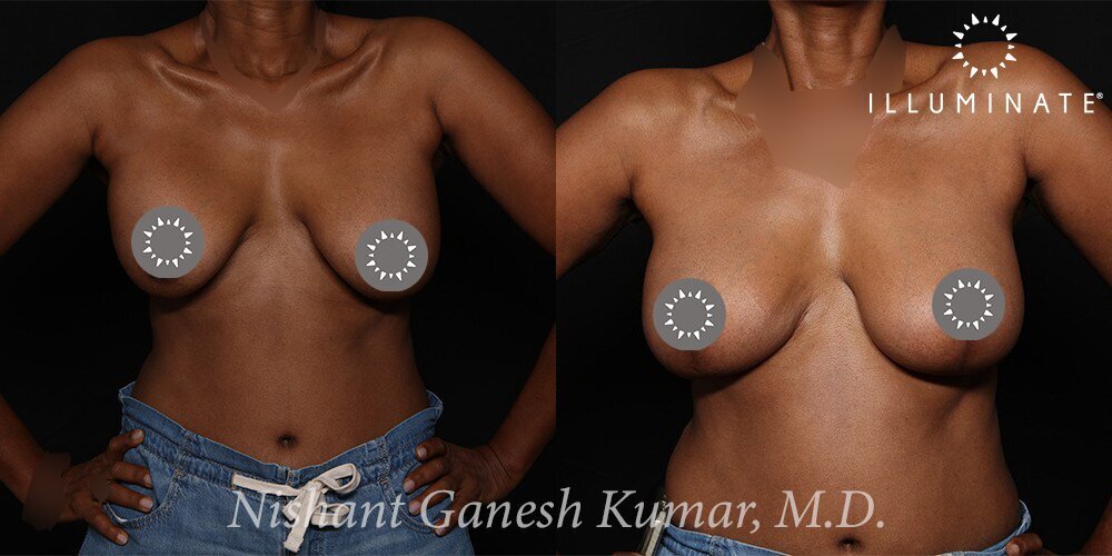 Mastopexy Before & After Image