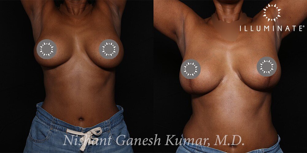 Mastopexy Before & After Image