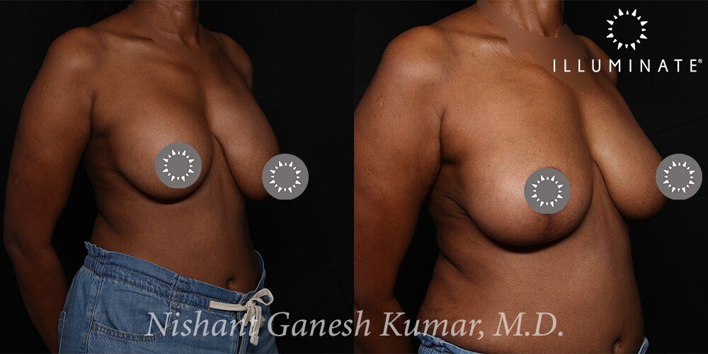 Mastopexy Before & After Image