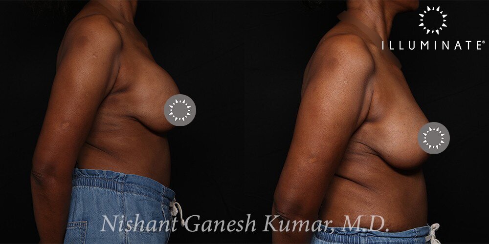 Mastopexy Before & After Image