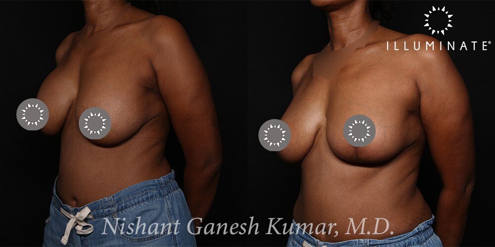 Mastopexy Before & After Image