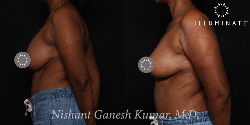 Mastopexy Before & After Image