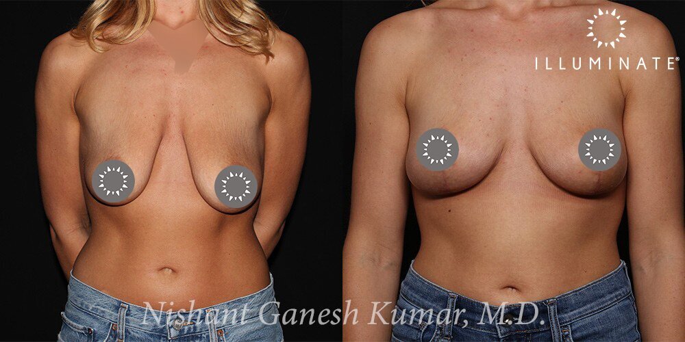 Mastopexy Before & After Image