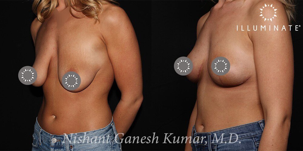 Mastopexy Before & After Image