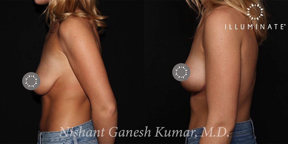 Mastopexy Before & After Image