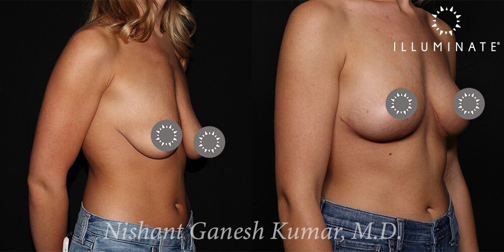 Mastopexy Before & After Image