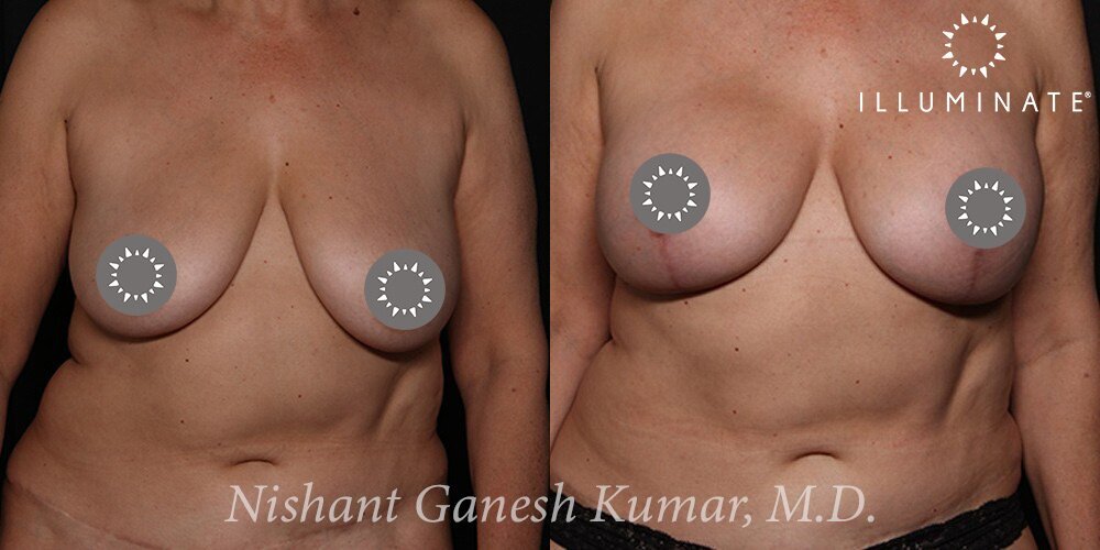 Mastopexy Before & After Image