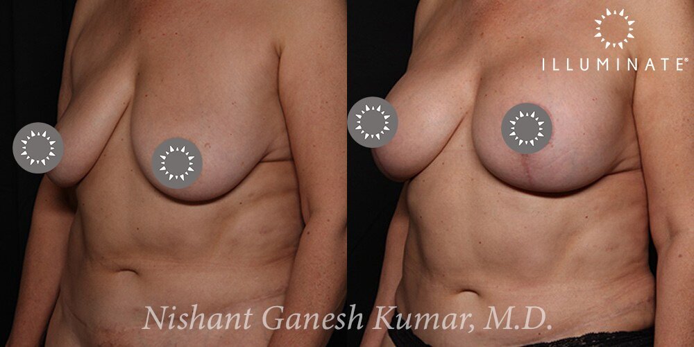 Mastopexy Before & After Image