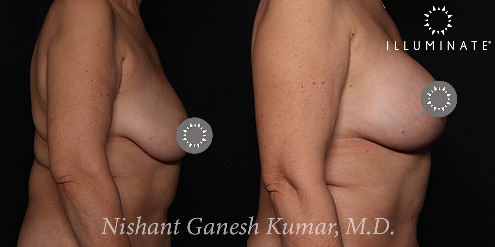 Mastopexy Before & After Image