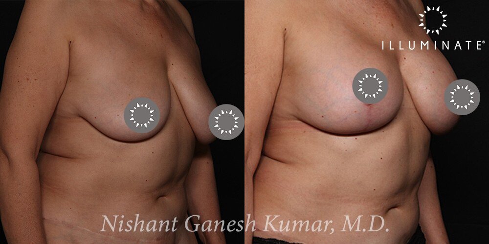 Mastopexy Before & After Image