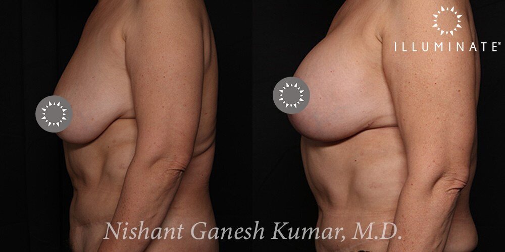 Mastopexy Before & After Image