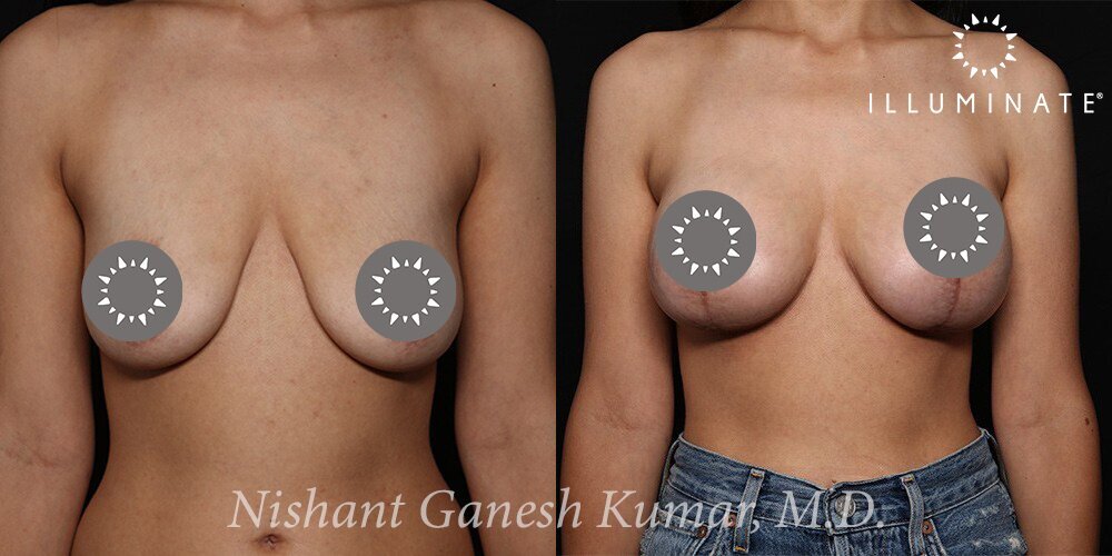 Mastopexy Before & After Image