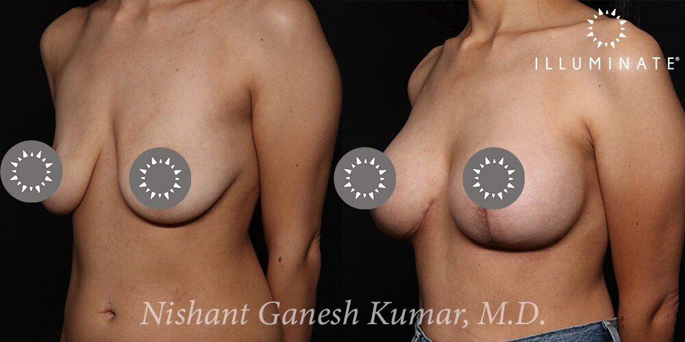 Mastopexy Before & After Image
