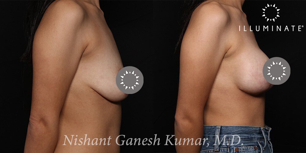 Mastopexy Before & After Image