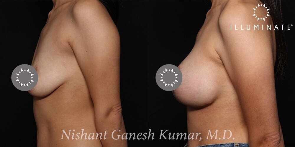 Mastopexy Before & After Image