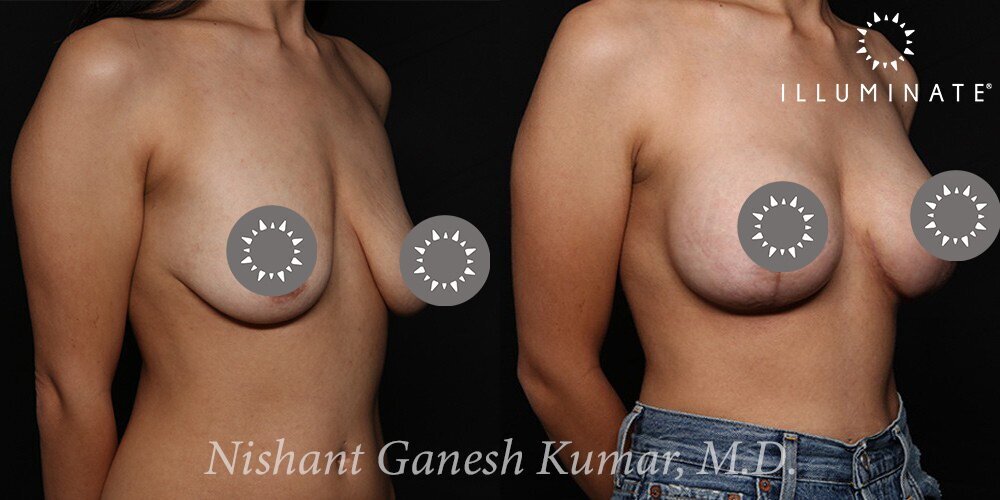 Mastopexy Before & After Image