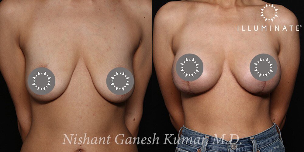 Mastopexy Before & After Image