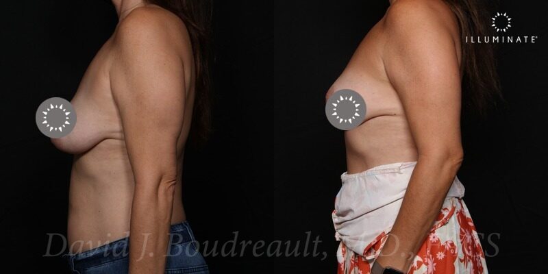 Mastopexy Before & After Image