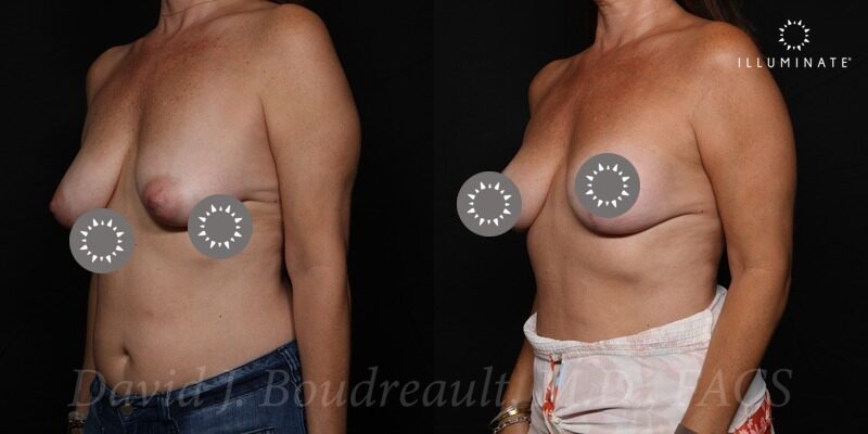 Mastopexy Before & After Image