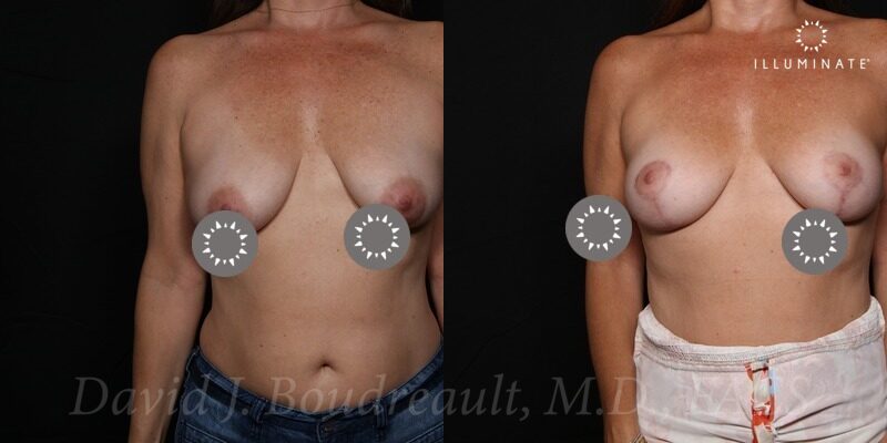 Mastopexy Before & After Image