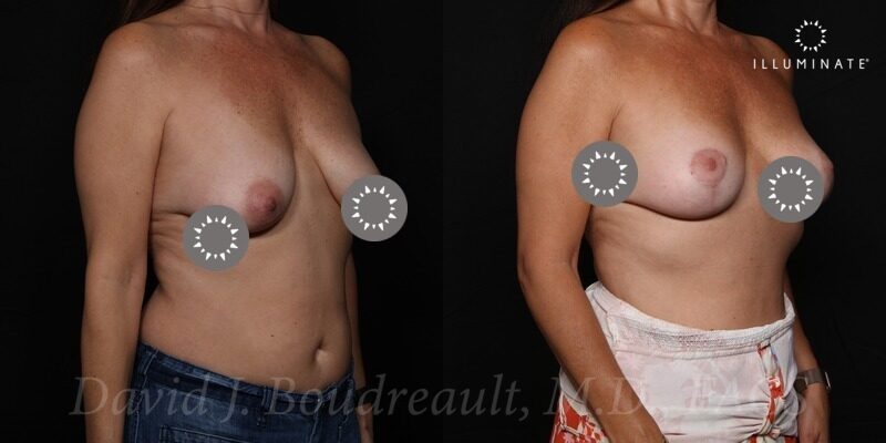 Mastopexy Before & After Image